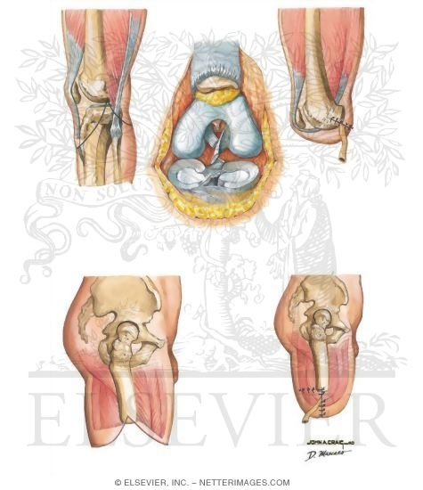 Watermarked preview of unlabeled image: Disarticulation of Knee