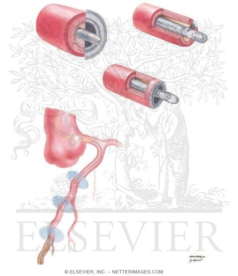 Watermarked preview of unlabeled image: Intravascular Ultrasonography