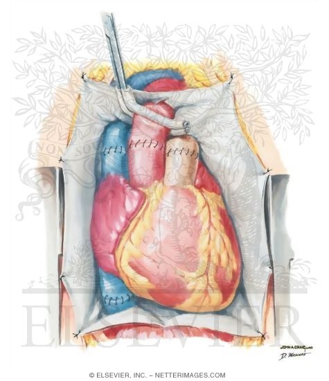 Transection of Aorta And Pulmonary Trunk
