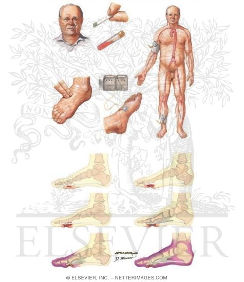 Watermarked preview of unlabeled image: Clinical Evaluation of Patient with Diabetic Foot Lesion