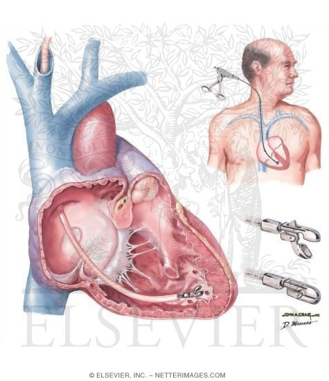 Watermarked preview of unlabeled image: Endomyocardial Biopsy