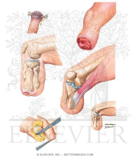 Complications of Amputation