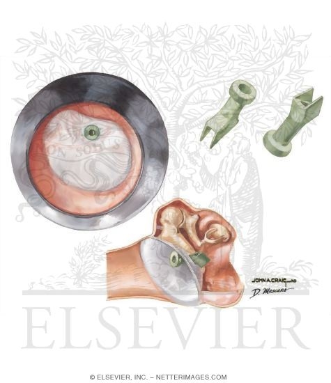 Watermarked preview of unlabeled image: Short-Term Middle Ear Aeration