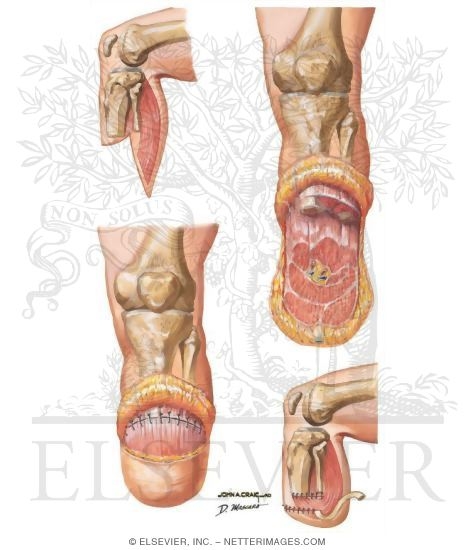 Below-Knee Amputation