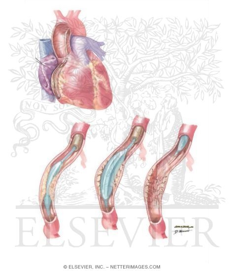 Percutaneous Transluminal Coronary Angioplasty (PTCA) Technique