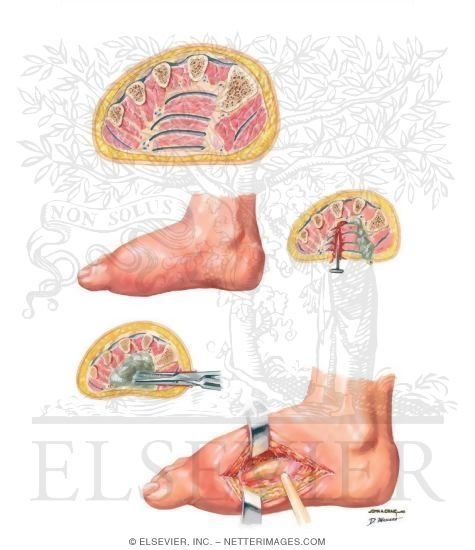 Deep Infections of Foot