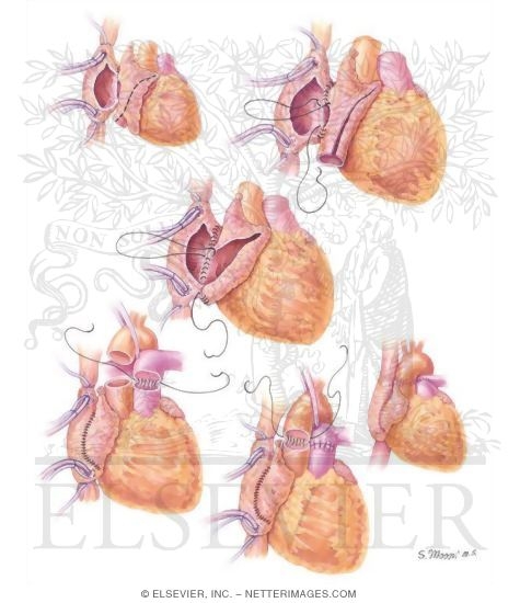 Technique of Orthotopic Biatrial Cardiac Transplantation
