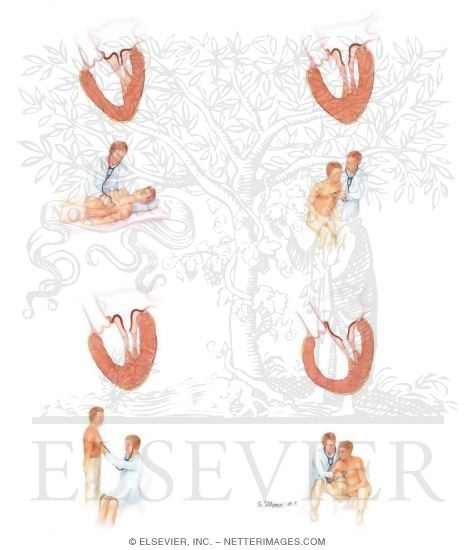 Watermarked preview of unlabeled image: Auscultation in Mitral Valve Prolapse