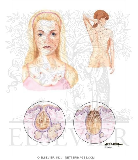 Watermarked preview of unlabeled image: Acne