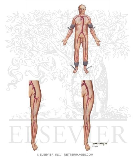 Watermarked preview of unlabeled image: Peripheral Vascular Disease