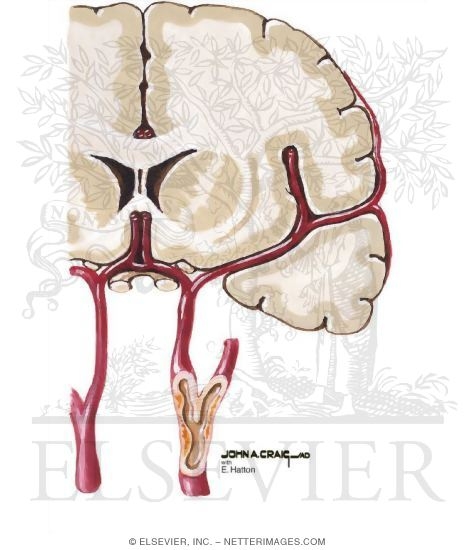 Carotid Artery Stenosis