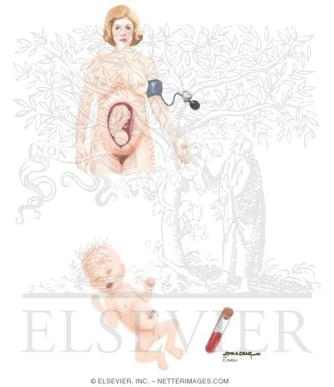 Intrauterine Growth Restriction (IUGR)