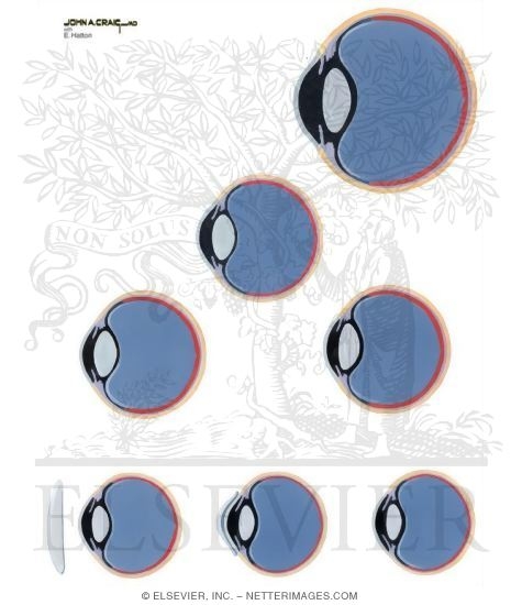 Watermarked preview of unlabeled image: Myopia and Other Refractive Errors