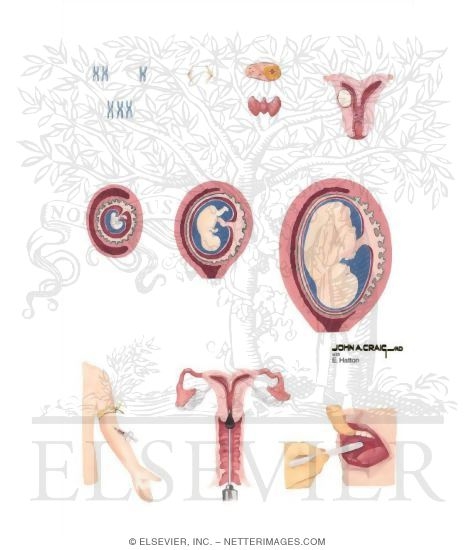 Watermarked preview of unlabeled image: Recurrent Abortion
Abortion: Recurrent