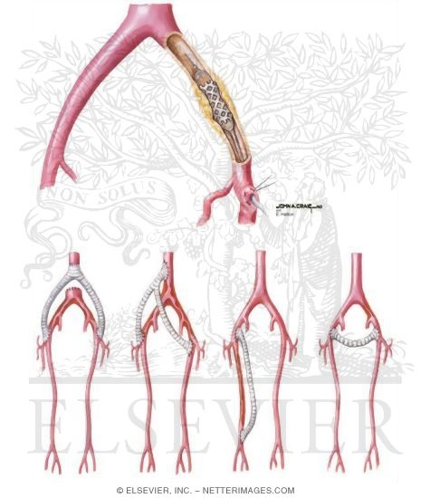 Watermarked preview of unlabeled image: Percutaneous Peripheral Angioplasty