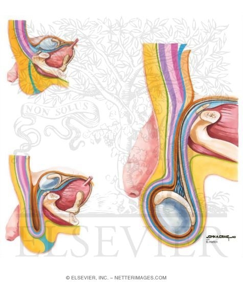 Coverings of the Spermatic Cord