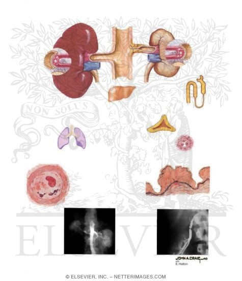 Watermarked preview of unlabeled image: Pathophysiology of Renovascular Hypertension in Unilateral Renal Artery Stenosis