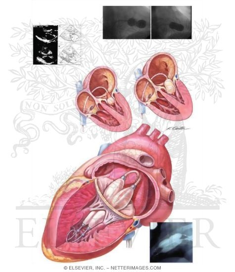 Mitral Balloon Valvuloplasty