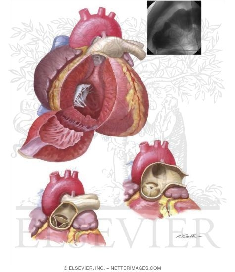 Pulmonary Stenosis