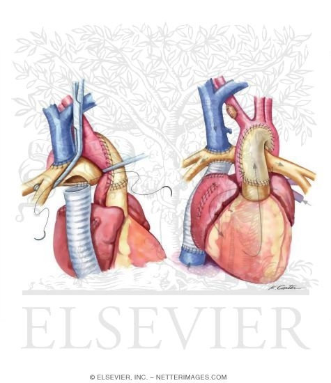 Watermarked preview of unlabeled image: Norwood Correction of HLHS: Fontan Circulation