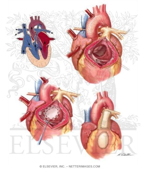 Watermarked preview of unlabeled image: Tetralogy of Fallot
