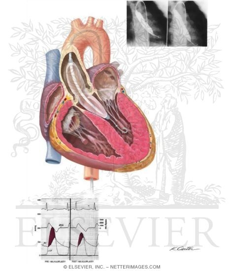 Aortic Balloon Valvuloplasty