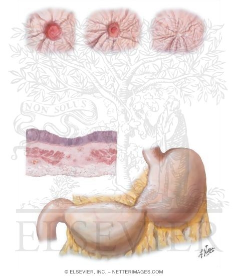 Illustration of Peptic Ulcer IX - Healing of Gastric Ulcer from the Netter Collection