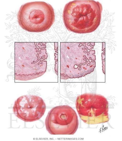 Cervicitis I - Erosions, Moniliasis, Trichomoniasis, Syphilis