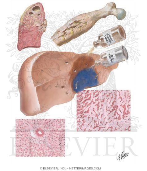 Watermarked preview of unlabeled image: Metabolic Injuries I - Amyloidosis