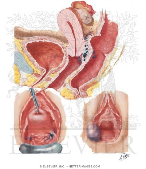 Endometriosis I - Vulva, Vagina, Cervix