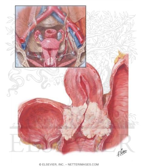 Cancer of Cervix III - Extension and Metastases