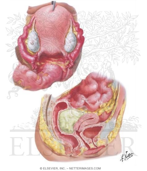 Pelvic Peritonitis, Abscess