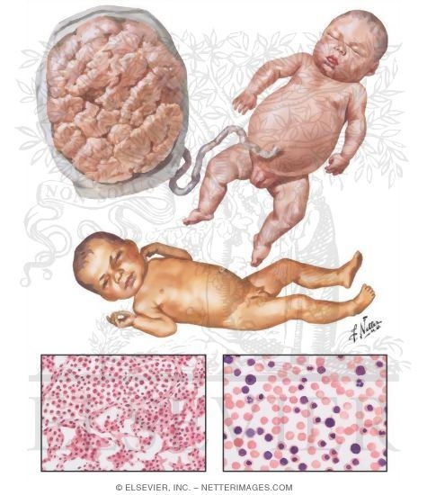 Erythroblastosis Fetalis