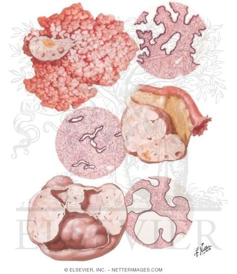 Surface Papilloma, Serous Adenofibroma, Serous Cystadenofibroma