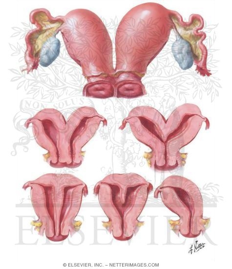 Uterine Anomalies: Bicornuate, Septate, and Unicornuate Uterus