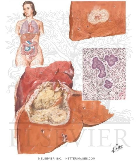 Watermarked preview of unlabeled image: Actinomycosis