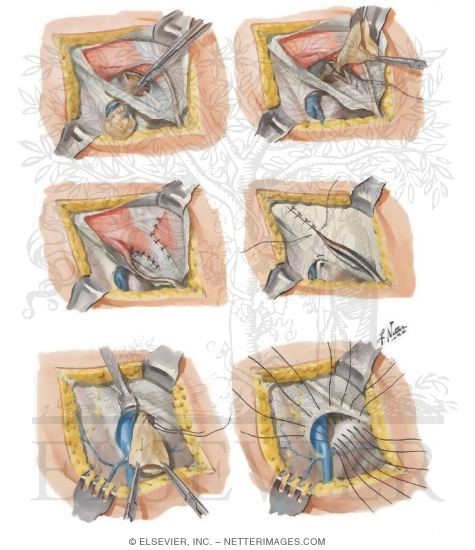 Hernia Ii - Femoral Hernia
