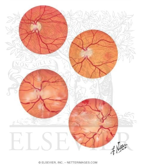 Acute Toxemia of Pregnancy II - Eyegrounds in Preeclampsia and Eclampsia