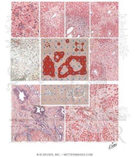 Watermarked preview of unlabeled image: Hepatic Necrosis