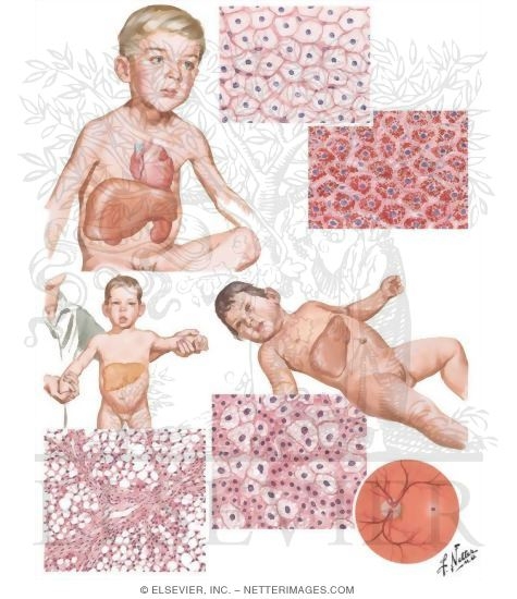 Metabolic Injuries II - Gierke's Disease, Galactosemia, Niemann-Pick's Disease