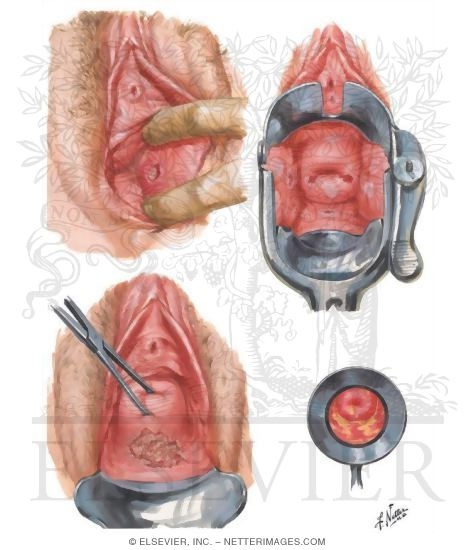 Vaginitis II: Gonorrhea, Syphilis, Tuberculosis