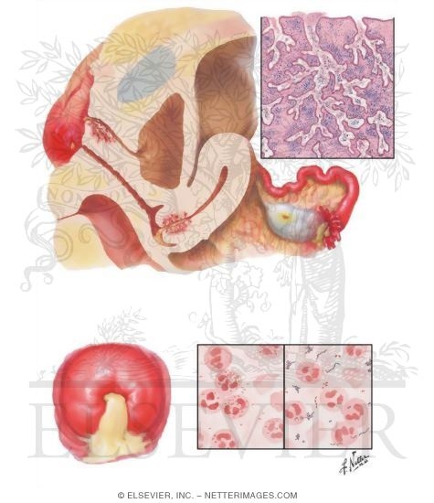 Cervicitis II - Gonorrhea, Pyogenic Infections
