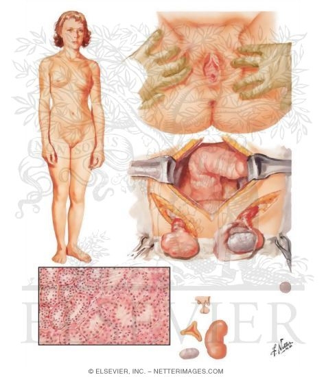 Male Pseudohermaphroditism II
