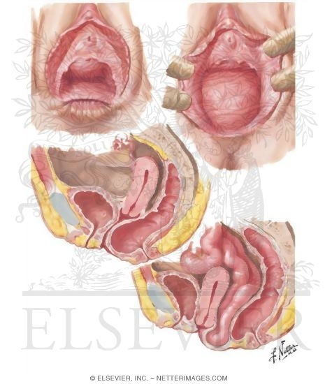 Rectocele, Enterocele