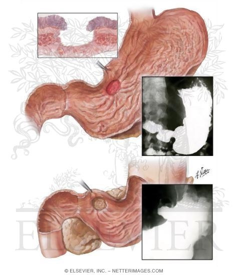 Peptic Ulcer III - Chronic Gastric Ulcer