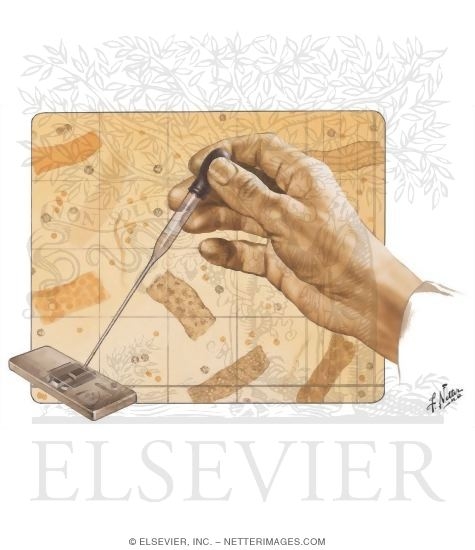 Watermarked preview of unlabeled image: Significance of the Urinary Sediment