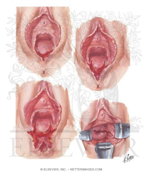 Obstetric Lacerations II - Vagina, Perineum, Vulva
Vaginal Lacerations