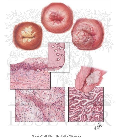 Cancer of Cervix II - Various Stages and Types