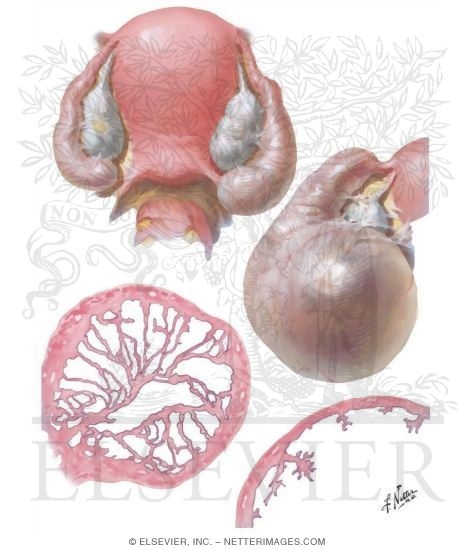 Hydrosalpinx