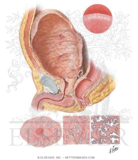 Benign Prostatic Hypertrophy I - Histologic Structure, Median Bar